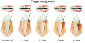 Почему зубы сводит: причины и способы предотвращения