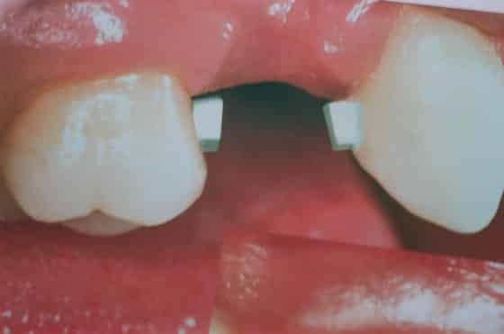 способ протезирования без обточки соседних зубов Crownless Bridgework